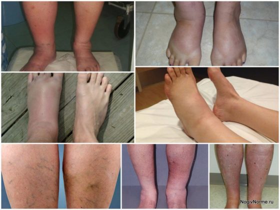 Отеки при варикозе - снимаем быстро и надолго