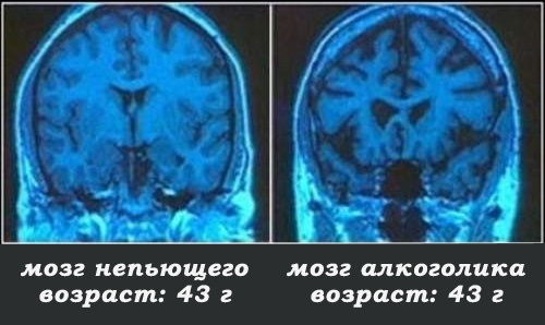 Сердце алкоголика и влияние алкоголя на него
