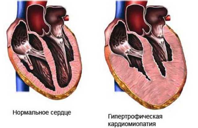 Гипертония 2 степени риск 2