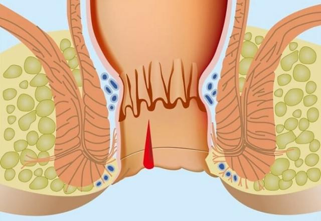 Трещина прямой кишки: симптомы, диагностика, лечение