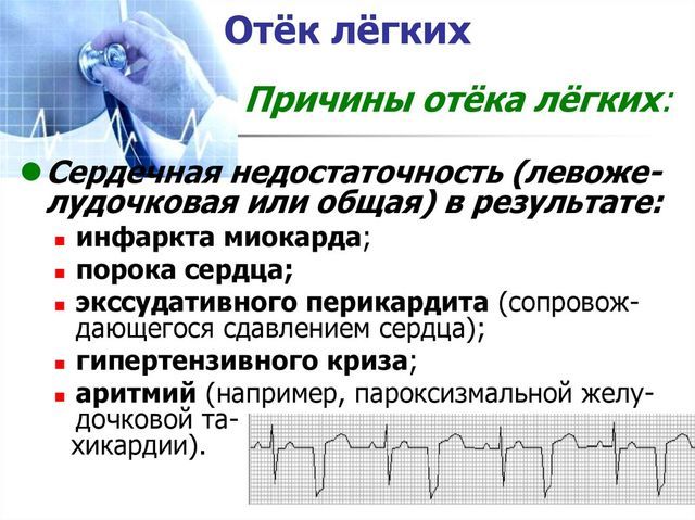 Застой в легких при сердечной недостаточности