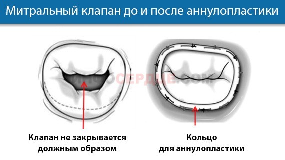 Трикуспидальная регургитация: степени, причины, лечение. Минимальная митральная регургитация что это такое