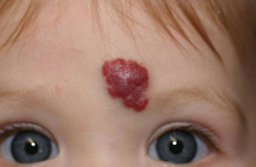 Внутренняя сонная артерия