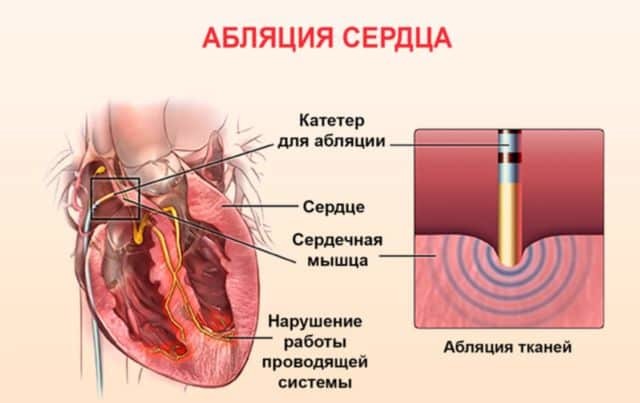 Инвалидность при ИБС - советы адвокатов и юристов