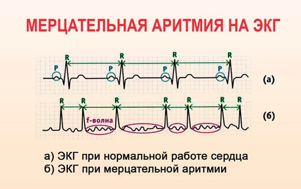 Картинки ЭКГ при нарушениях ритма