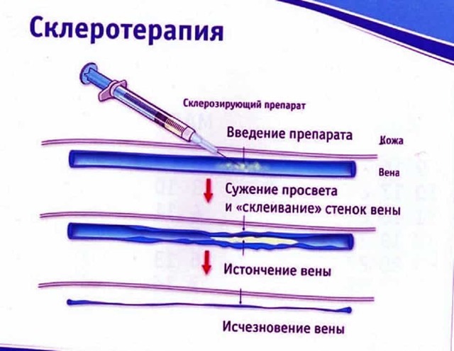Кдо что это такое | Все о ретикулярном варикозе