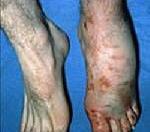 Синдром длительного раздавливания (СДР)