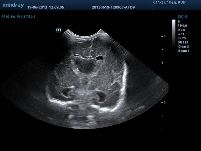 УЗДГ или МРТ: что лучше для обследования сосудов шеи?