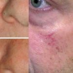 Как убрать сосудистые звездочки на лице в домашних условиях, лечение купероза