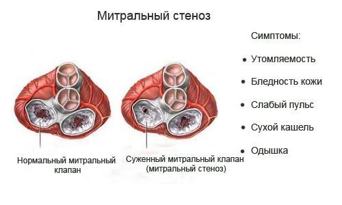 Кашель при сердечной недостаточности - Гипертонии нет