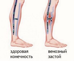 Застой в малом тазу у мужчин симптомы. Венозный застой крови в малом тазу и его последствия