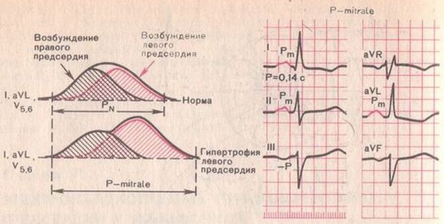 Гипертрофия и увеличение правого желудочка. Изменения ЭКГ при гипертрофии правого желудочка