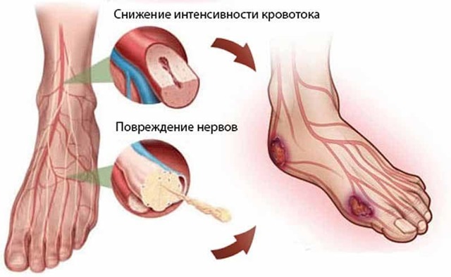 Гипертоническая макроангиопатия сосудов - симптомы, лечение