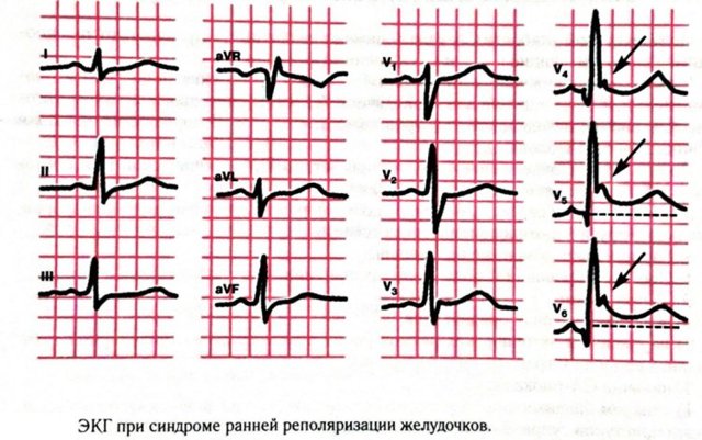 Диффузное нарушение процесса реполяризации: причины
