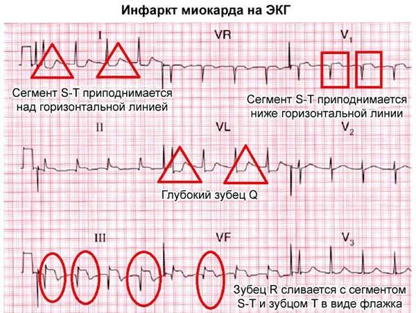Инфаркт миокарда на ЭКГ: признаки, расшифровка