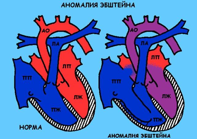 Операция при пороке сердца у ребенка как проходит -