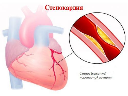 Как отличить сердечную боль от остеохондроза