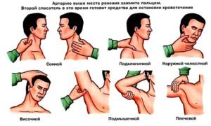 Кровотечения и способы их остановки