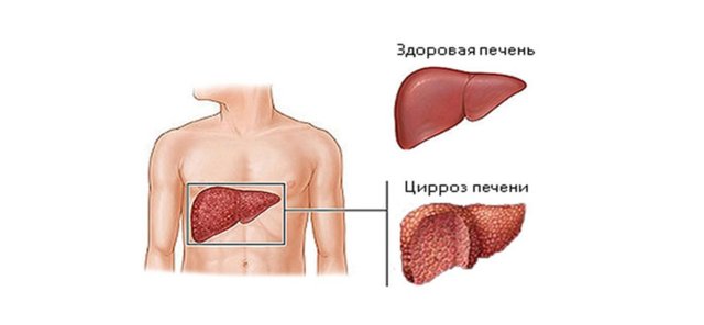 Варикозное расширение вен в желудке