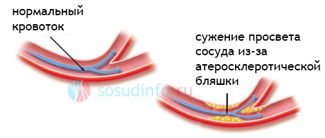 Сосуды головного мозга: симптомы, диагностика, лечение