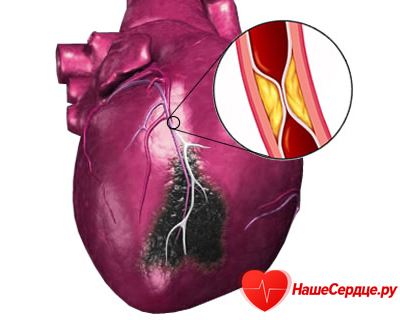 Инфаркт задней стенки сердца прогноз - Всё о сердце