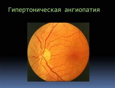 Сосуды глазного дна у ребенка расширены - Лечение гипертонии