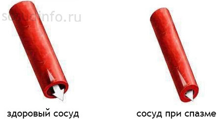 Спазм сосудов головного мозга: симптомы, лечение таблетками, травы снимающие боль и как быстро избавиться от недуга