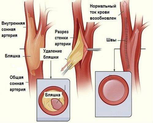 Атеросклероз сосудов нижних конечностей - симптомы и лечение - Всё о склерозе