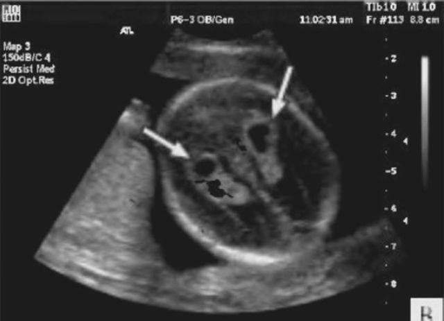 Киста сосудистого сплетения головного мозга: возникновение, диагностика, лечение. Опасна ли киста сосудистого сплетения для новорожденного?