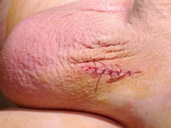 Видео операции варикоцеле яичка: процесс и исход