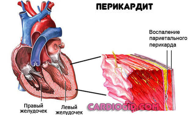 ПМК 1 степени - симптомы, лечение, диагностика