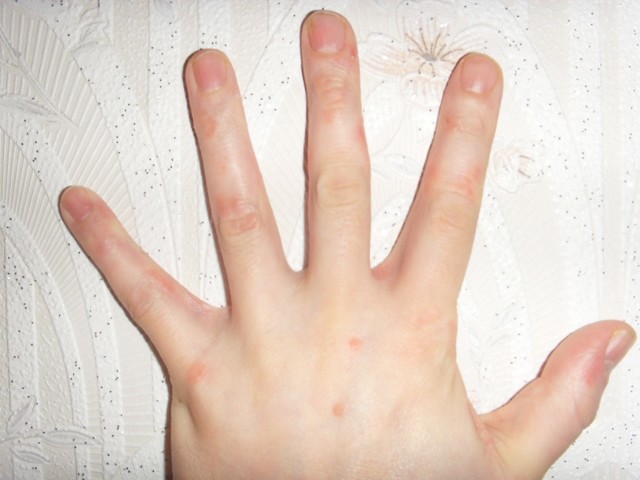 Лечение псориаз на руках - фото, симптомы, виды псориаза на руках