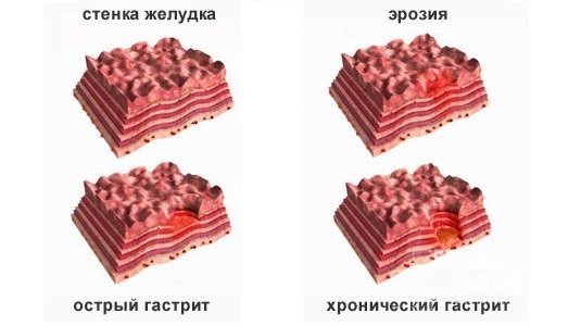 Эрозивный гастрит – симптомы, лечение, диета, осложнения, профилактика