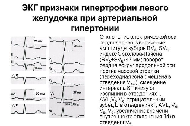 Гипертрофия левого предсердия что это такое - Всё о сердце