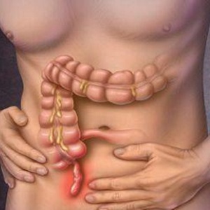 Хронический аппендицит у женщин и мужчин – симптомы, диагностика, лечение