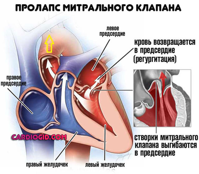 ПМК 1 степени - симптомы, лечение, диагностика