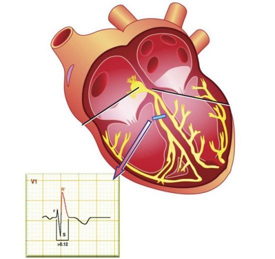 ЭКГ при блокаде правой ножки пучка Гиса (ПНПГ)