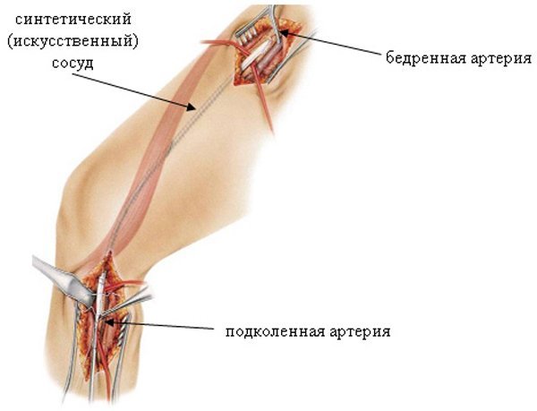 Операция по чистке сосудов нижних конечностей