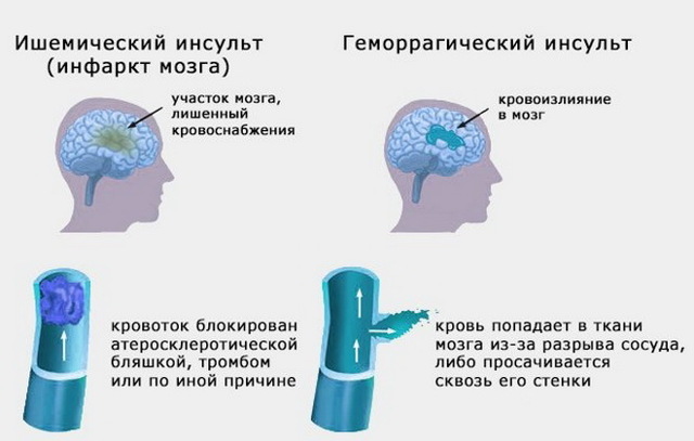 Инсульт - причины, симптомы, диагностика и лечение