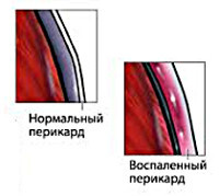 Хронический перикардит, симптомы хронического перикардита