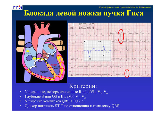 Блокада левой ножки пучка гиса на экг — Сердце