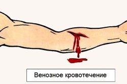 Венозная кровь человека в отличие от артериальной. Отличия венозной и артериальной крови