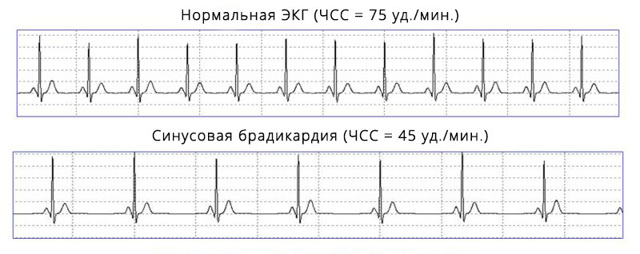 Расшифровка ЭКГ — норма и отклонения, выявление патологий