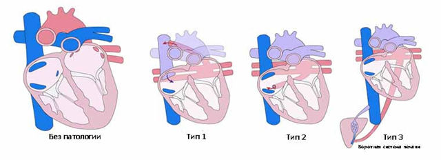 Анатомия сосудов легких. Легочная артерия