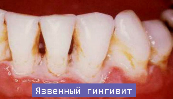 Острый, язвенно-некротический гингивит Венсана: лечение, симптомы и диагностика