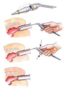 Криодеструкция геморроя - описание процедуры, отзывы