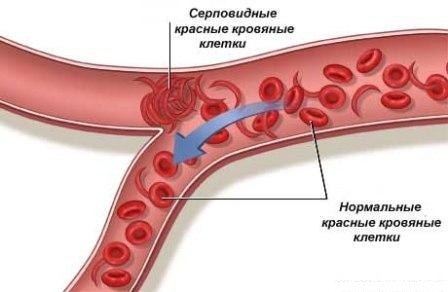 Анемия - формы, лечение, причины, симптомы, диагностика