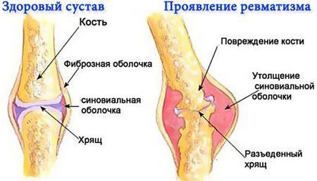 Ревматизм - причины, признаки, симптомы и лечение