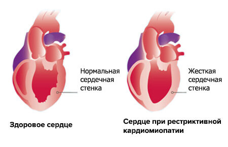 Кардиомиопатия сердца: симптомы и лечение
