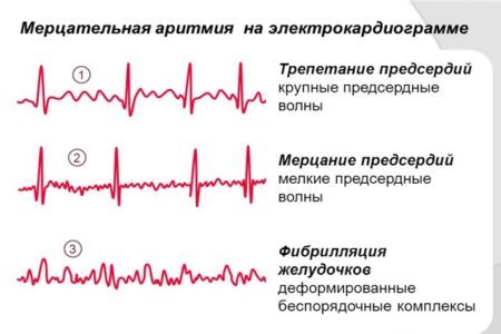Виды аритмии сердца — типы, разновидности и их главные особенности